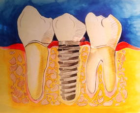 Groveland Dental Implant Watercolor